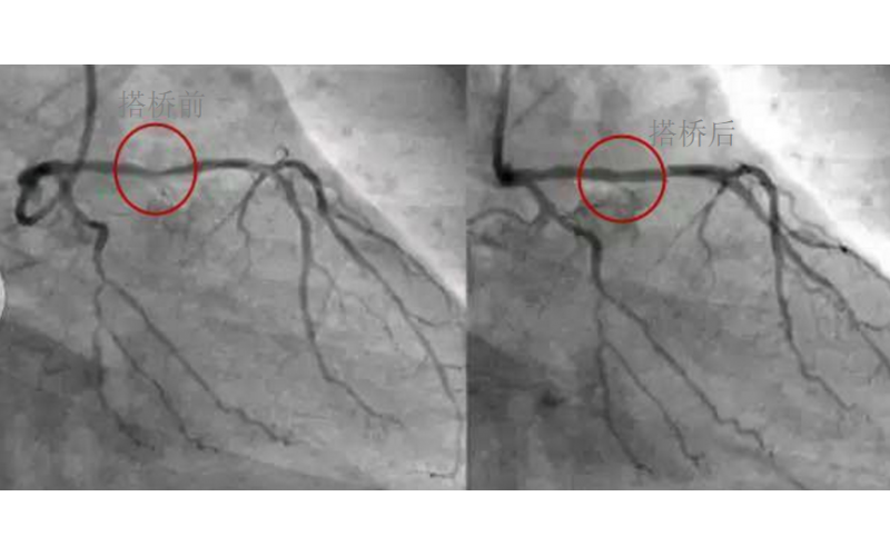 深圳市乐竞网页版入口厂对心脏支架的关注，国产化的道路有多长？
